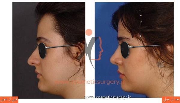 جراحی زیبایی بینی