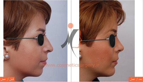 جراحی زیبایی بینی و جراحی چانه