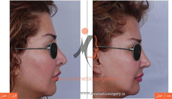 ترمیم بینی در بیماری که قبلا توسط جراحان دیگری عمل شده است