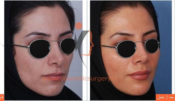ترمیم بینی به همراه تزریق چربی