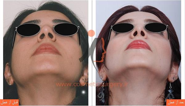 جراحی زیبایی بینی