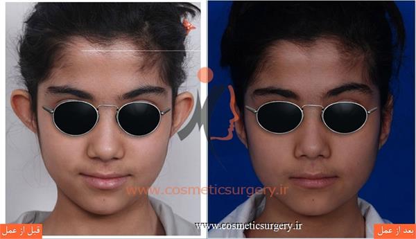 جراحی گوش ( ترمیم گوش برجسته )