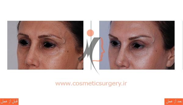 لیفت ابرو به همراه تزریق چربی