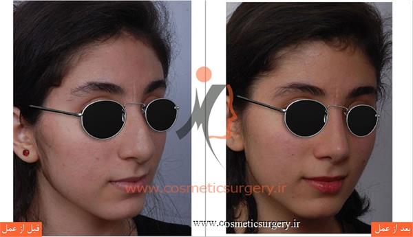 عمل جراحی بینی گوشتی