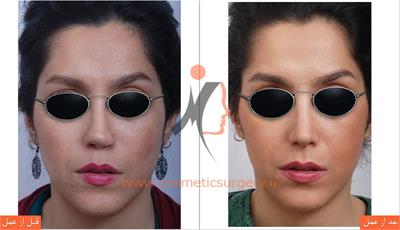 ترمیم بینی عمل شده توسط جراحان دیگر ( عمل بینی ثانویه )