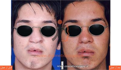 جراحی زیبایی بینی به همراه ترمیم شکاف لب و کام