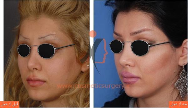 ترمیم بینی عمل شده توسط جراحان دیگر به همراه بلندتر کردن بینی و افزایش تناسب بینی