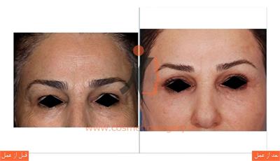 جراحی پلک بالا